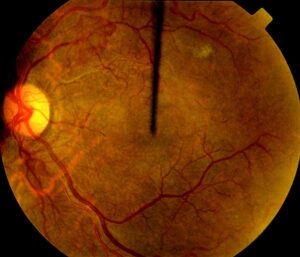 Clinical eye photograph illustrating Systemic Sclerosis Scleroderma Eye Retinal Findings