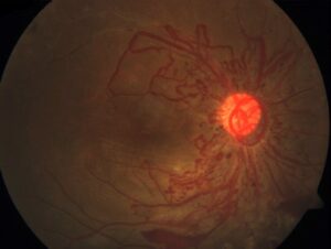 Clinical eye photograph illustrating Takayasu Retinopathy Stages Ocular Signs