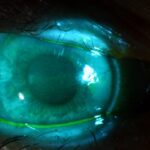 Clinical eye photograph illustrating Tear Break Up Time
