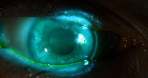 Clinical eye photograph illustrating Tear Break Up Time