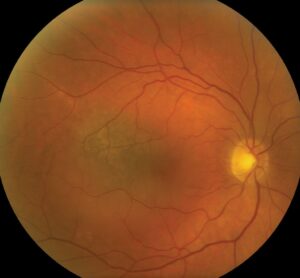 Clinical eye photograph illustrating Tebentafusp Metastatic Uveal Melanoma