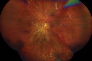 Clinical eye photograph illustrating Tessellated Fundus Choroidal Vessel Visibility