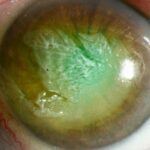 Clinical eye photograph illustrating Thermal Burn Ocular Surface Management