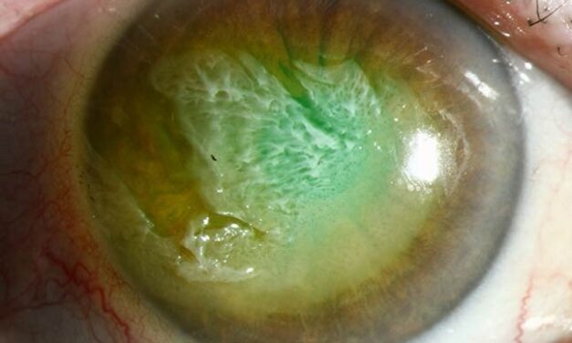 Thermal Burns of the Ocular Surface: A Different Injury Pattern From a Chemical Burn