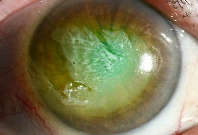 Thermal Burns of the Ocular Surface: A Different Injury Pattern From a Chemical Burn