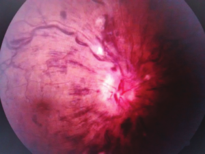 Clinical eye photograph illustrating Thrombophilia Testing Retinal Vein Occlusion Workup