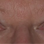 Clinical eye photograph illustrating Thyroid Eye Disease Lid Signs