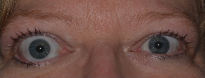Clinical eye photograph illustrating Thyroid Eye Disease Lid Signs