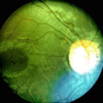 Clinical eye photograph illustrating Tigroid Fundus