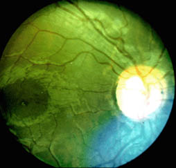 Tigroid Fundus: Reading the Choroidal Stripes of a Thinning Retina