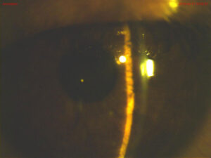 Clinical eye photograph illustrating Topiramate Angle Closure