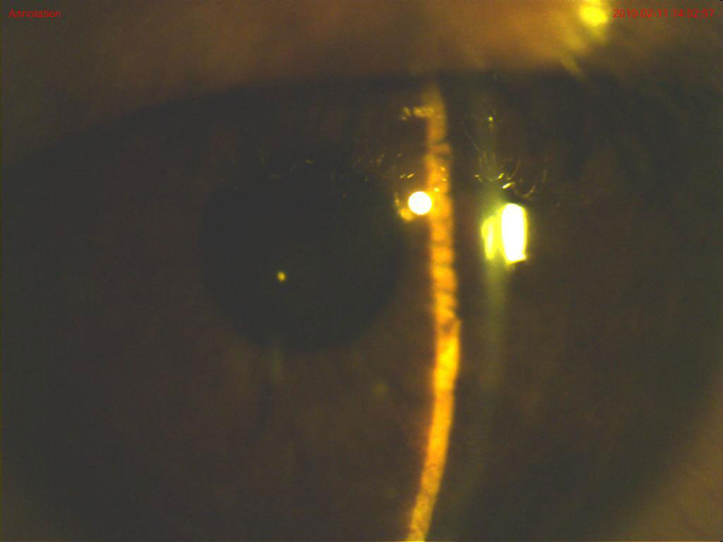 Clinical eye photograph illustrating Topiramate Angle Closure