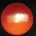 Clinical eye photograph illustrating Toric Iol Misalignment