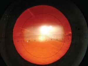 Clinical eye photograph illustrating Toric Iol Misalignment