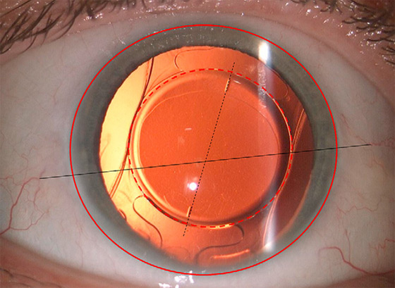 Clinical eye photograph illustrating Toric Iol Misalignment