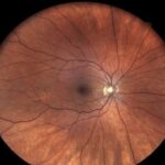 Clinical eye photograph illustrating Tortuous Retinal Vessels