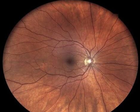 Tortuous Retinal Vessels: When the Vasculature Itself Is the Diagnostic Clue