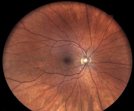 Tortuous Retinal Vessels: When the Vasculature Itself Is the Diagnostic Clue
