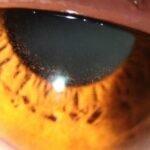 Clinical eye photograph illustrating Toxic Epitheliopathy Preservative Induced