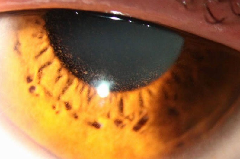 Preservative-Induced Toxic Epitheliopathy: The Hidden Cost of Chronic Drop Use