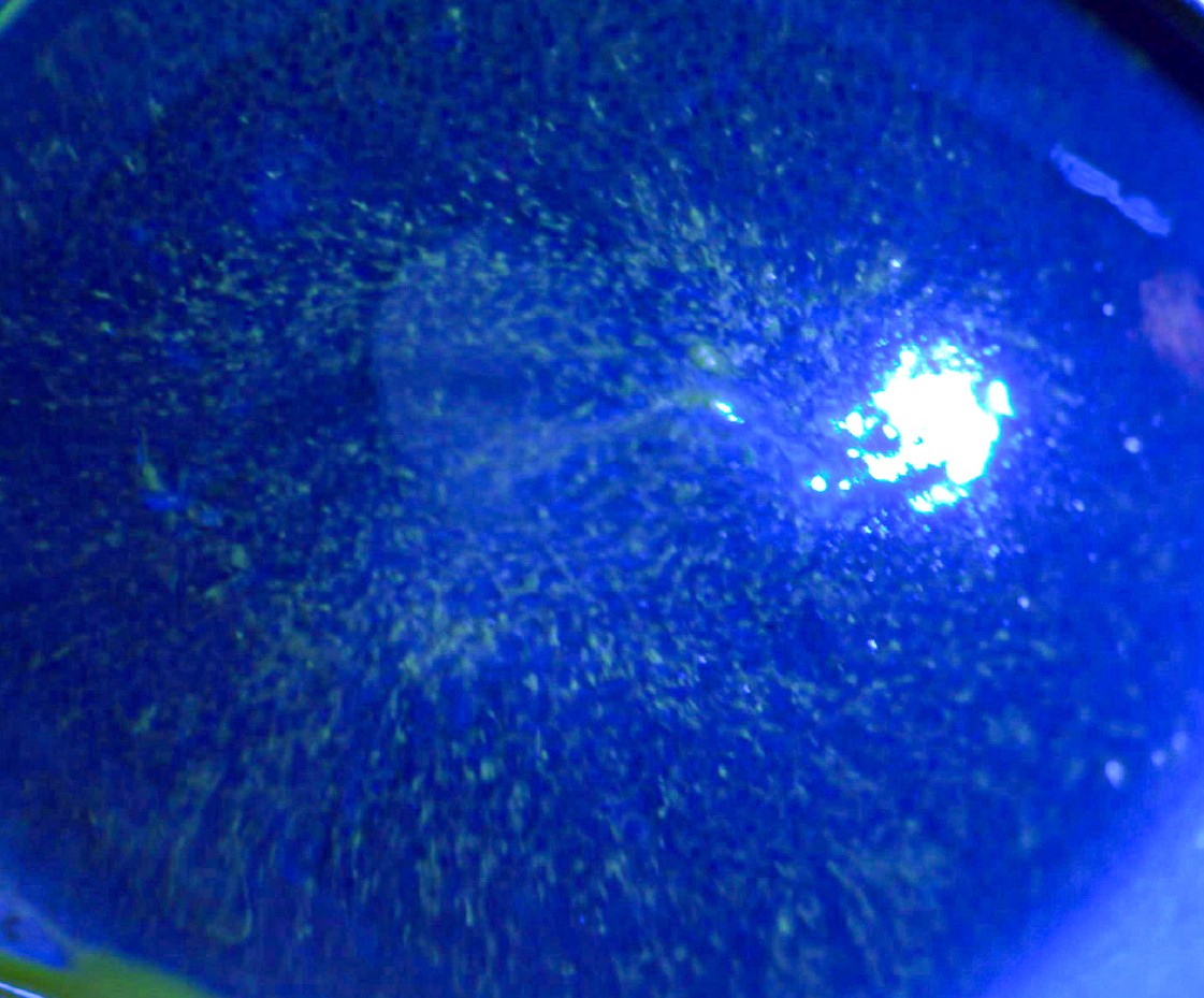 Clinical eye photograph illustrating Toxic Epitheliopathy Preservative Induced