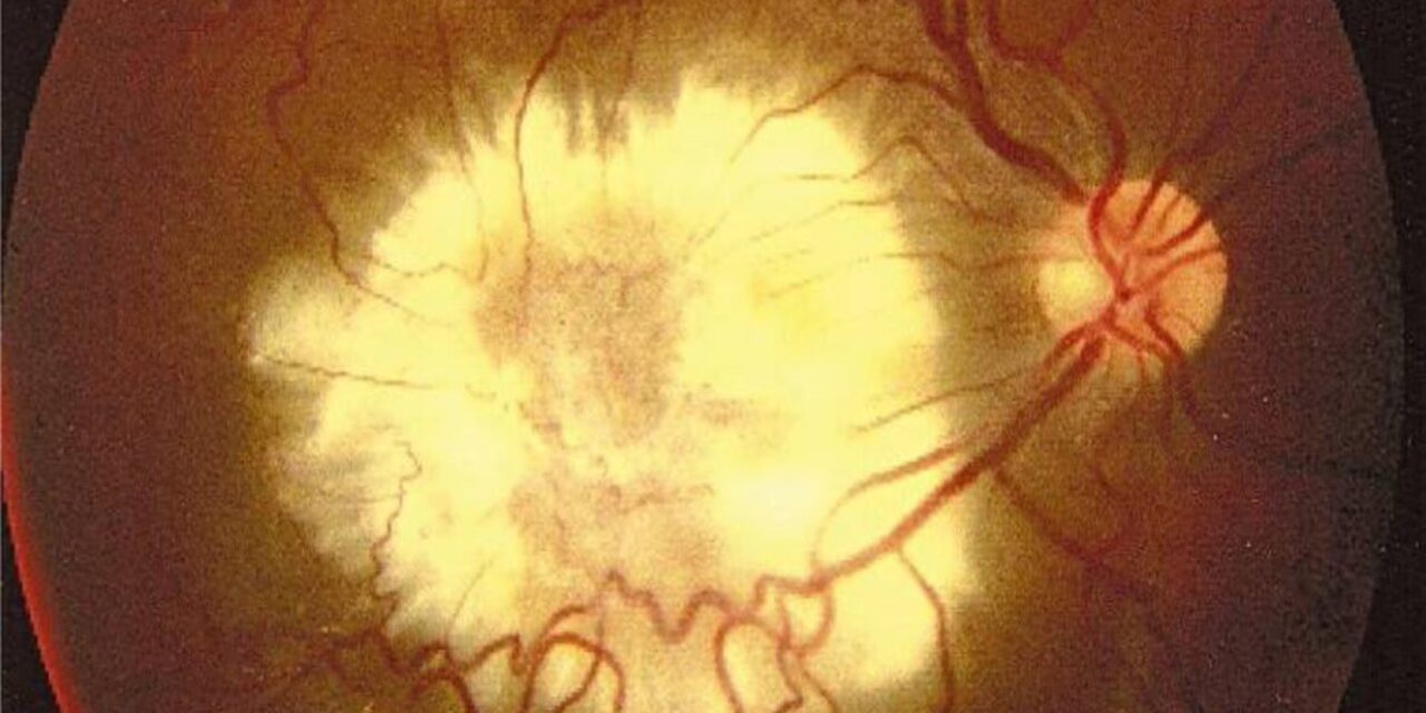 Ocular Toxocariasis: The Peripheral Granuloma From a Wandering Larva