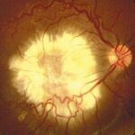 Clinical eye photograph illustrating Toxocara Ocular Granuloma