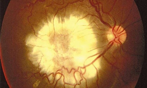 Ocular Toxocariasis: The Peripheral Granuloma From a Wandering Larva