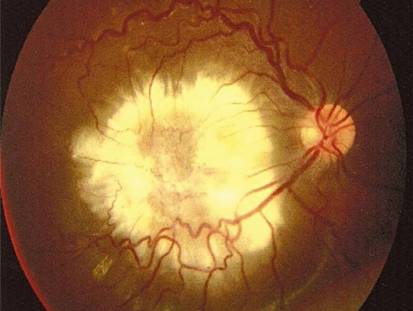 Clinical eye photograph illustrating Toxocara Ocular Granuloma