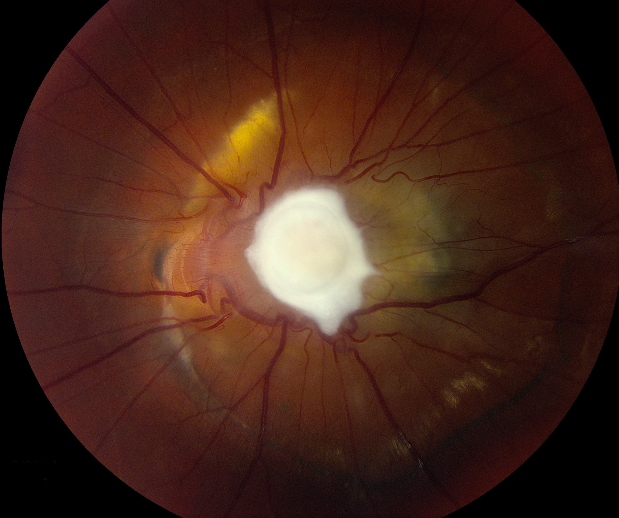 Clinical eye photograph illustrating Toxocara Ocular Granuloma