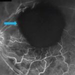 Clinical eye photograph illustrating Toxoplasma Retinochoroiditis Treatment