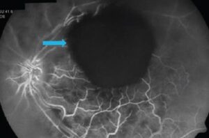 Clinical eye photograph illustrating Toxoplasma Retinochoroiditis Treatment