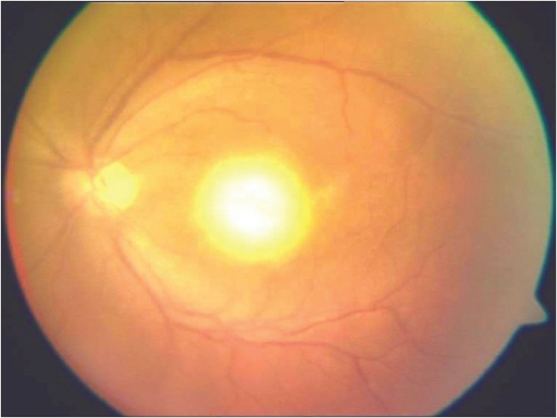 Clinical eye photograph illustrating Toxoplasma Retinochoroiditis Treatment
