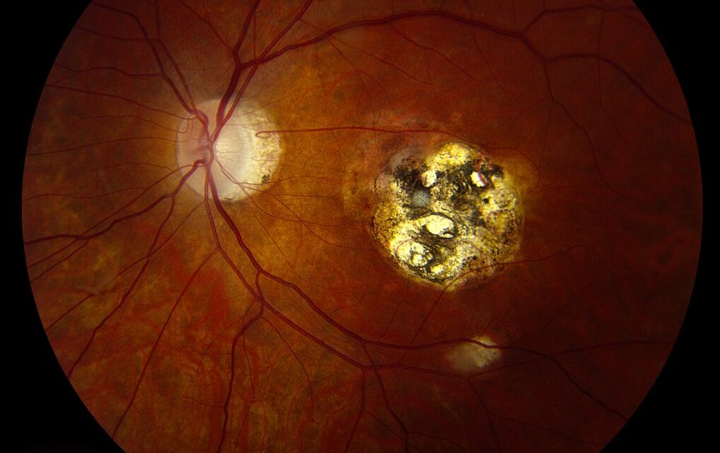 Toxoplasmosis Chorioretinal Scars: Reading the Fundus for Signs of Reactivation