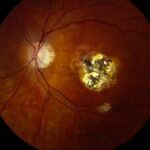 Clinical eye photograph illustrating Toxoplasmosis Chorioretinal Scar Reactivation