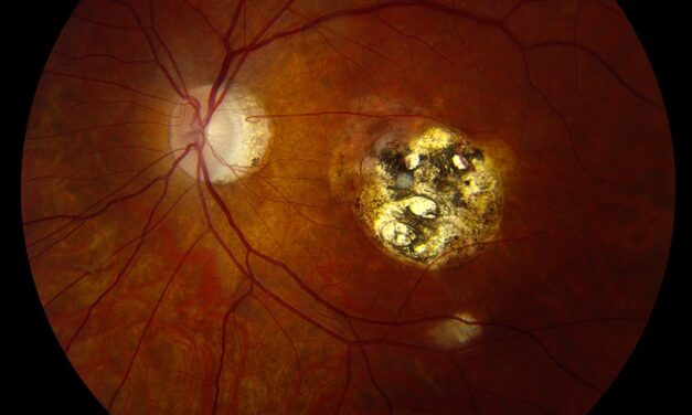 Toxoplasmosis Chorioretinal Scars: Reading the Fundus for Signs of Reactivation