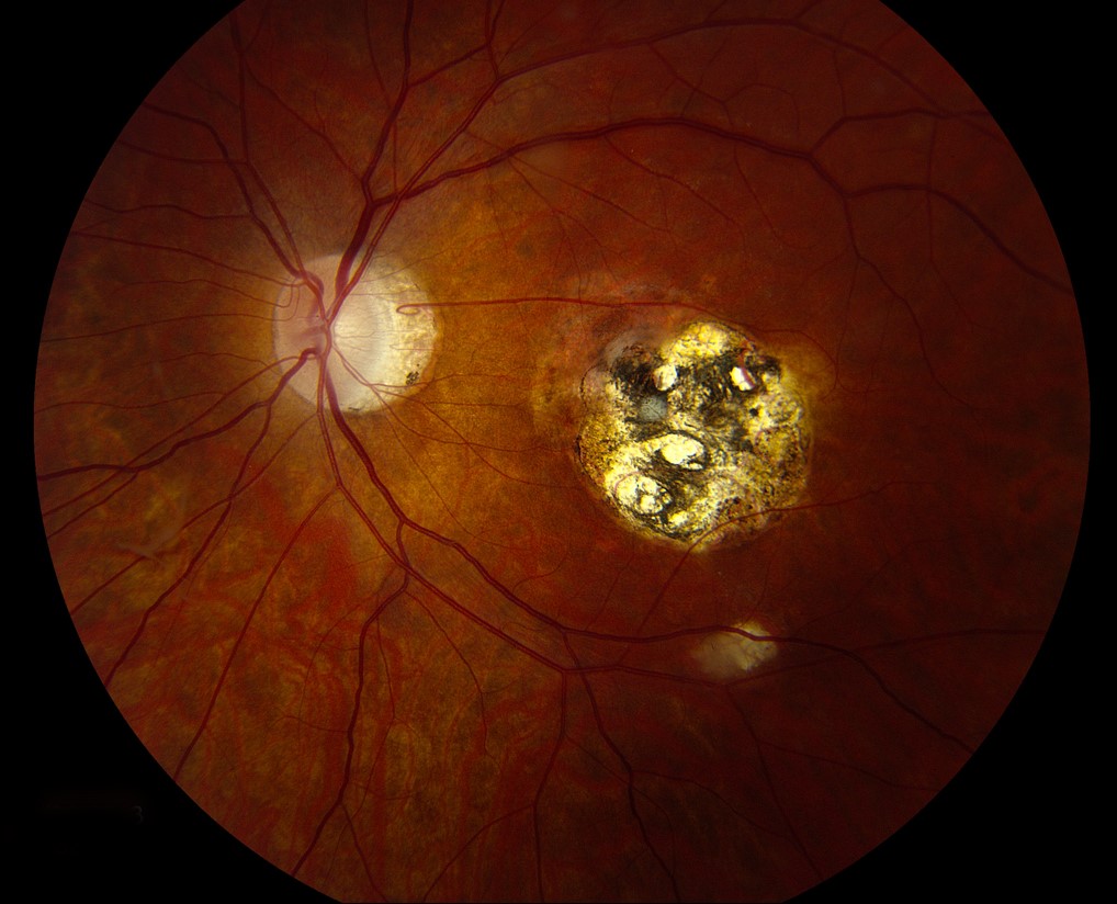 Clinical eye photograph illustrating Toxoplasmosis Chorioretinal Scar Reactivation