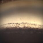 Clinical eye photograph illustrating Trabecular Meshwork Pigmentation Grading