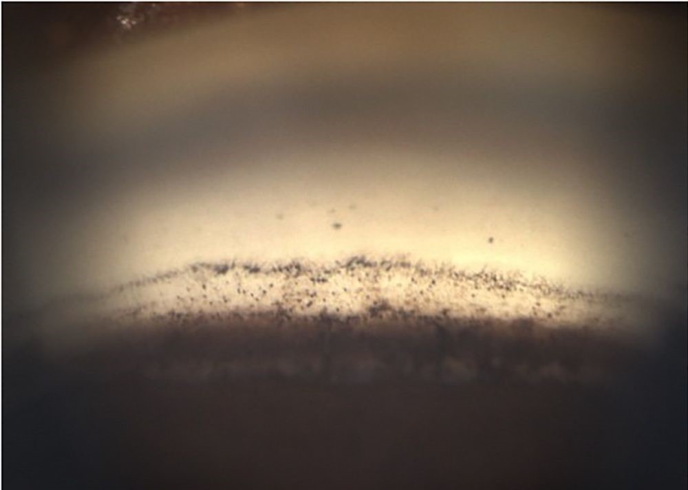 Clinical eye photograph illustrating Trabecular Meshwork Pigmentation Grading