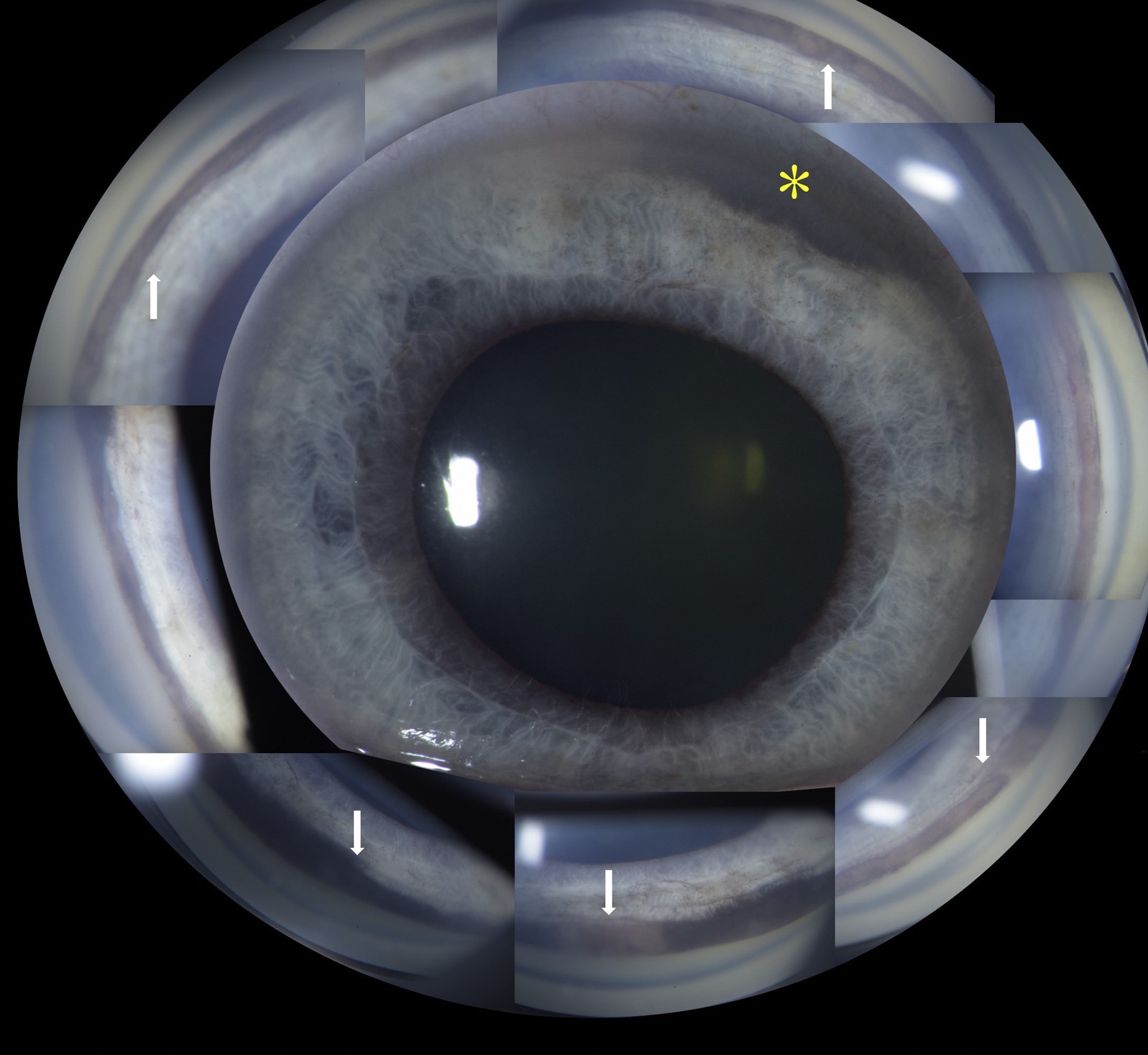 Clinical eye photograph illustrating Trabecular Meshwork Pigmentation Grading