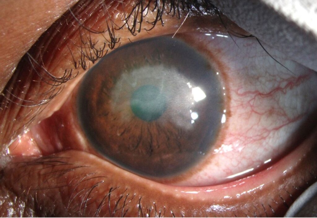 Clinical eye photograph illustrating Traumatic Iritis