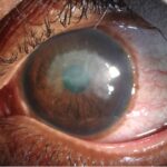 Clinical eye photograph illustrating Traumatic Iritis