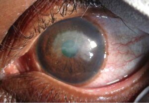 Clinical eye photograph illustrating Traumatic Iritis