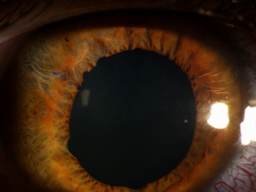 Clinical eye photograph illustrating Traumatic Mydriasis Sphincter Tears