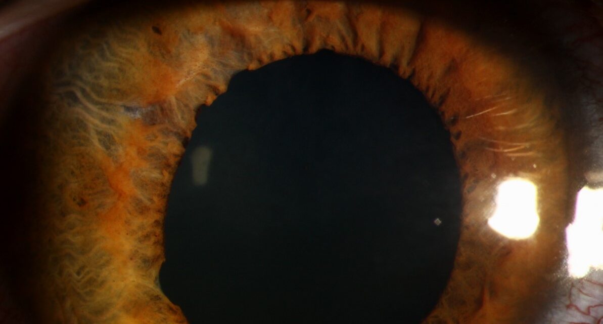 Traumatic Mydriasis and Sphincter Tears: What Blunt Injury Does to the Pupil
