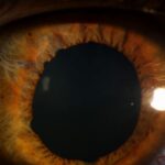 Clinical eye photograph illustrating Traumatic Mydriasis Sphincter Tears