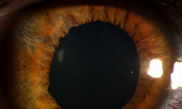 Traumatic Mydriasis and Sphincter Tears: What Blunt Injury Does to the Pupil