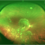 Clinical eye photograph illustrating Tubercular Serpiginous Like Choroiditis