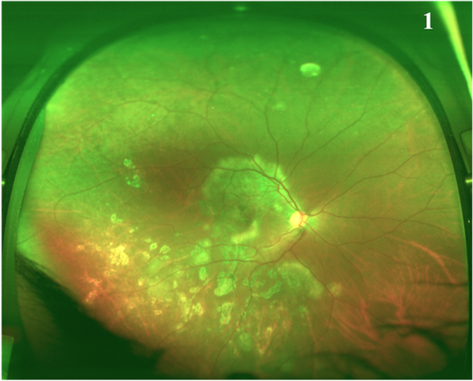 Tubercular Serpiginous-Like Choroiditis: Serpiginous Disease With an Infectious Cause