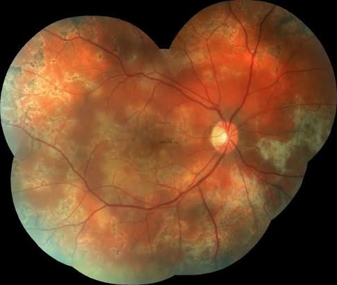 Clinical eye photograph illustrating Tubercular Serpiginous Like Choroiditis
